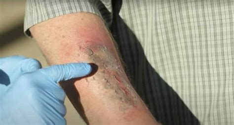 how to wash battery acid off skin|Battery Acid on Skin: How to Treat a Chemical Burn